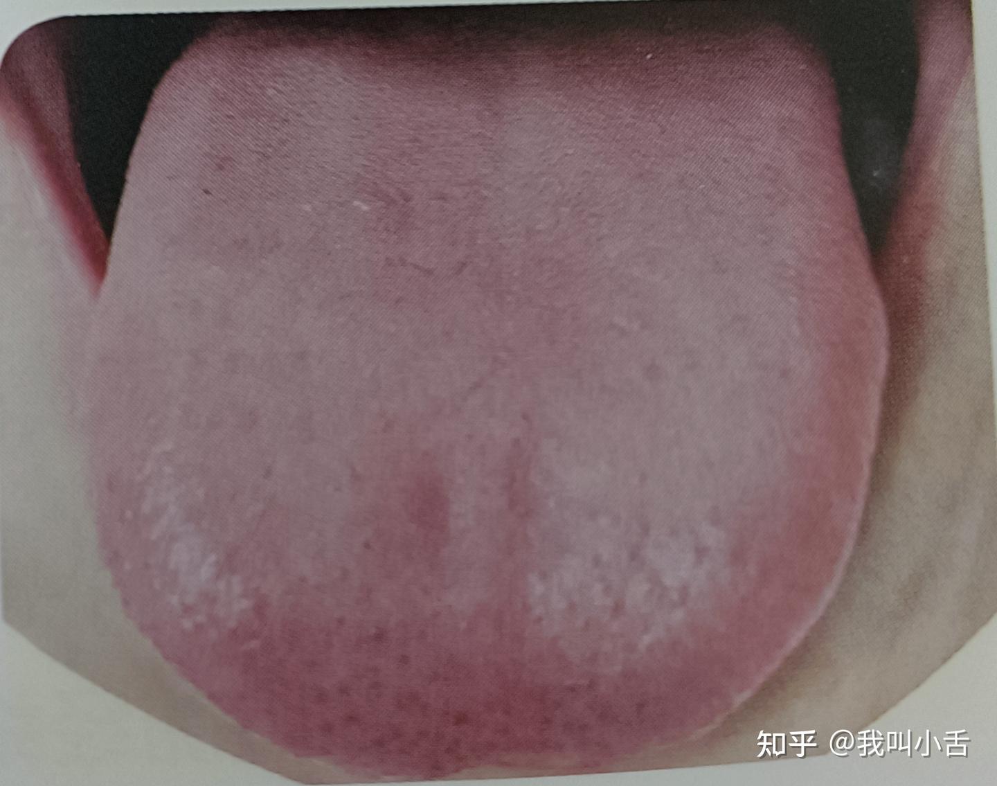 你的舌头有异常吗?上面是不是有红色的小颗粒?(进来看看点刺舌长什么样) - 知乎