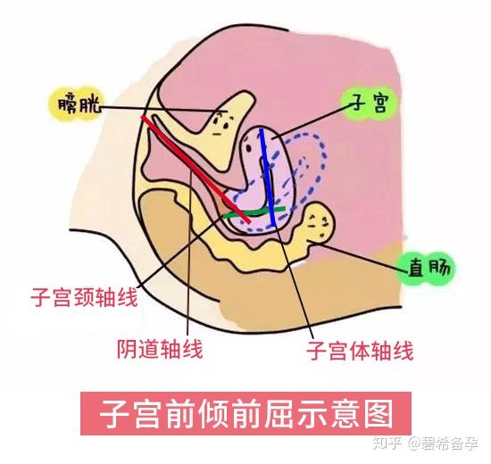 子宫前倾前屈图片