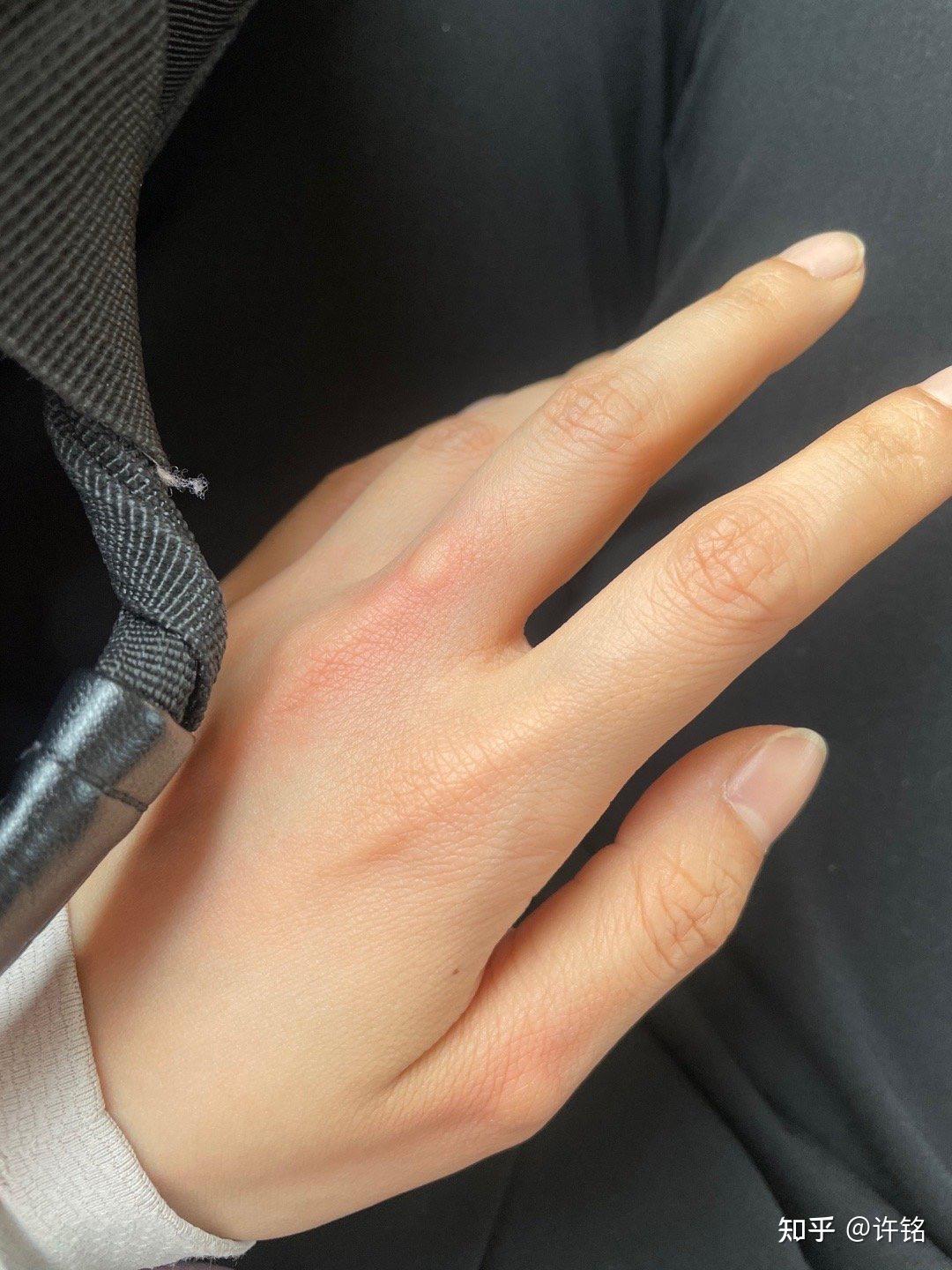 大家有被蚊子叮包后的奇葩照片吗? - 知乎