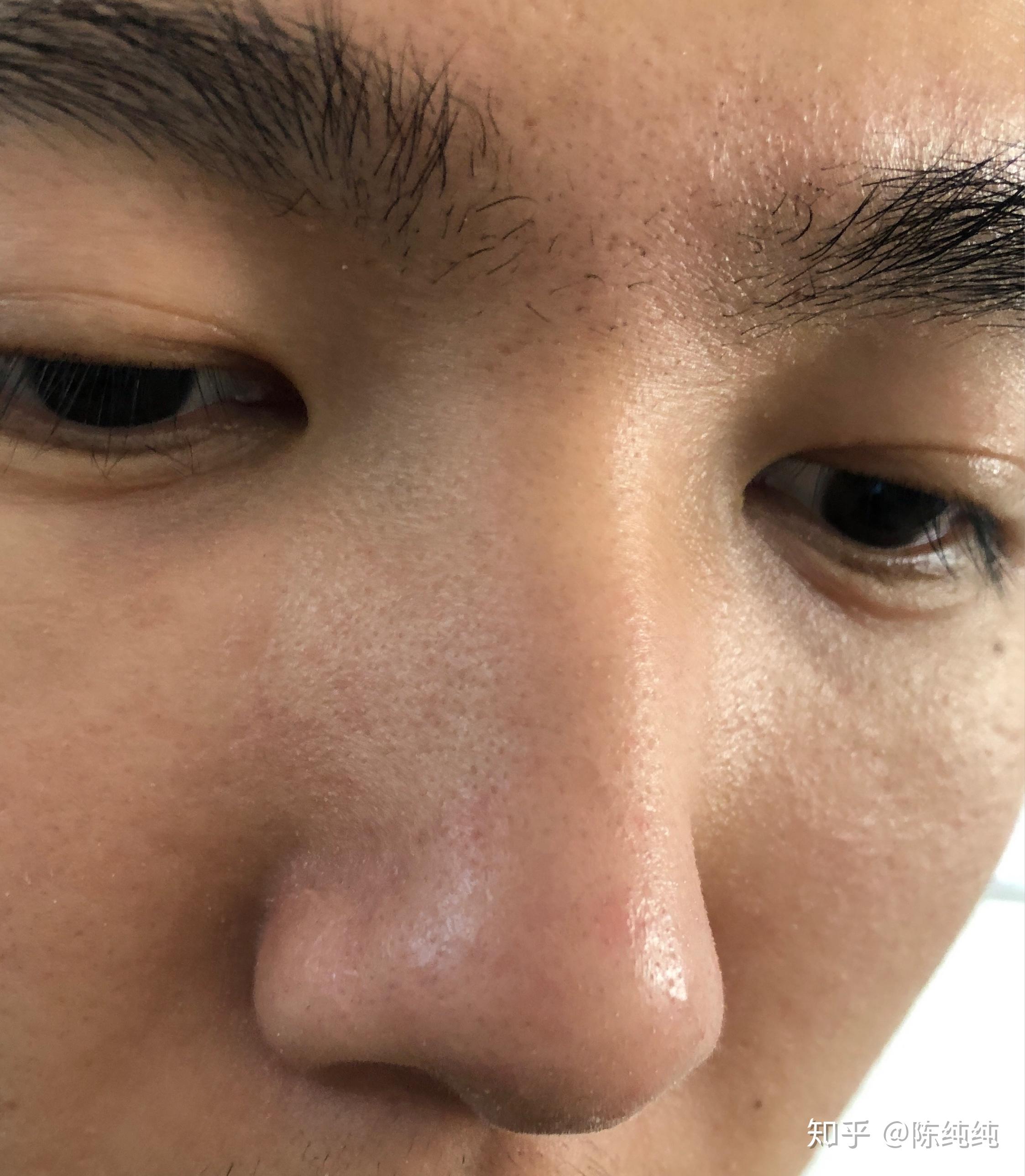 怎么去除黑头粉刺? - 知乎