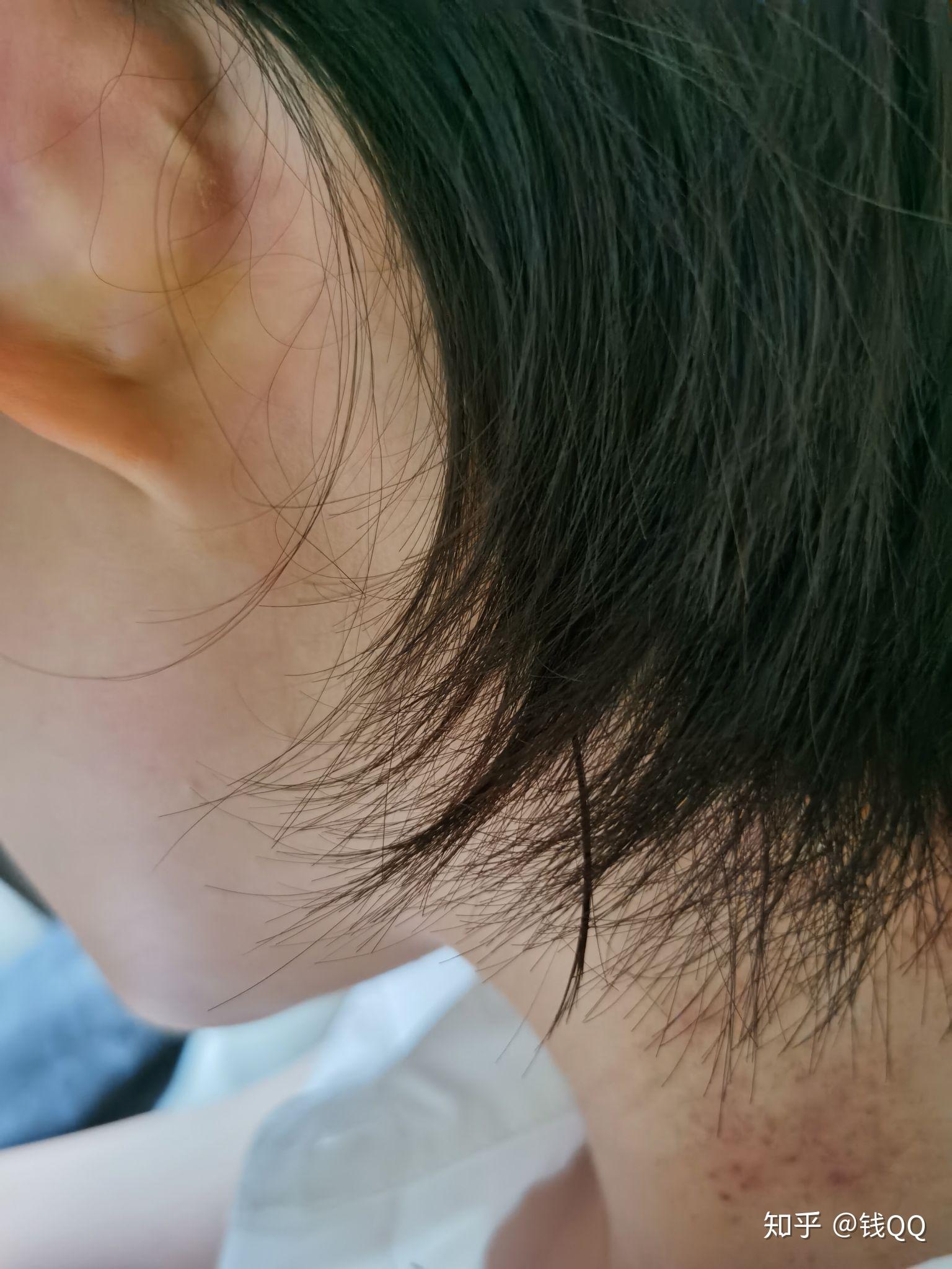 耳朵后面起了一个小包包