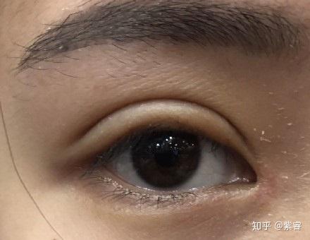 什么是双眼皮肉条感