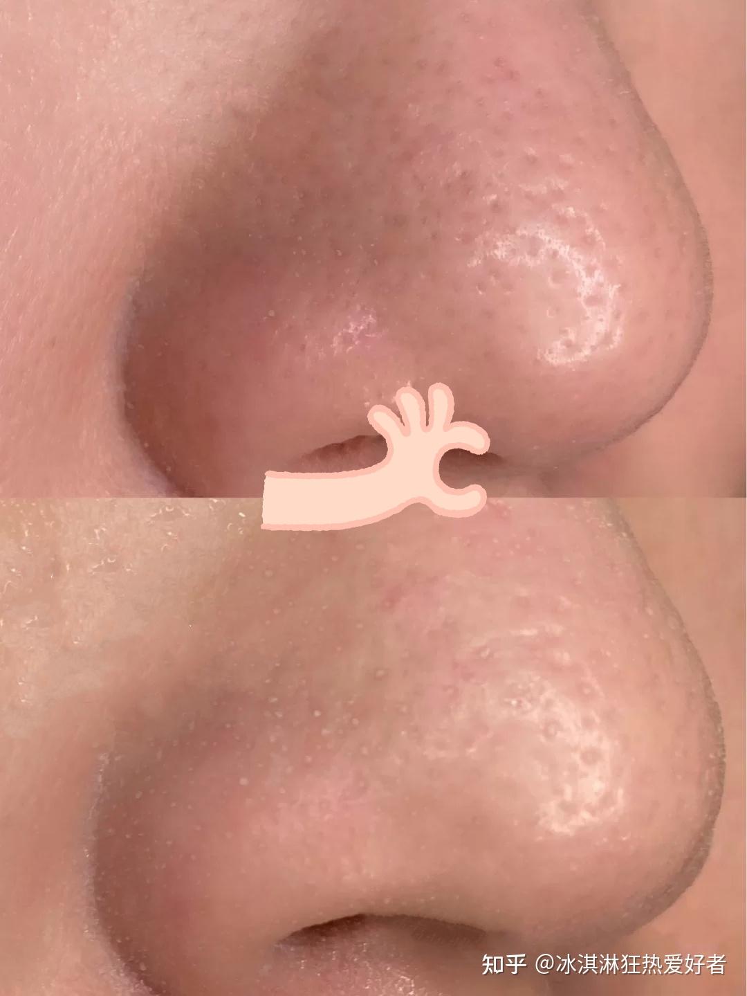 挤黑头应该如何处理留下的洞洞?