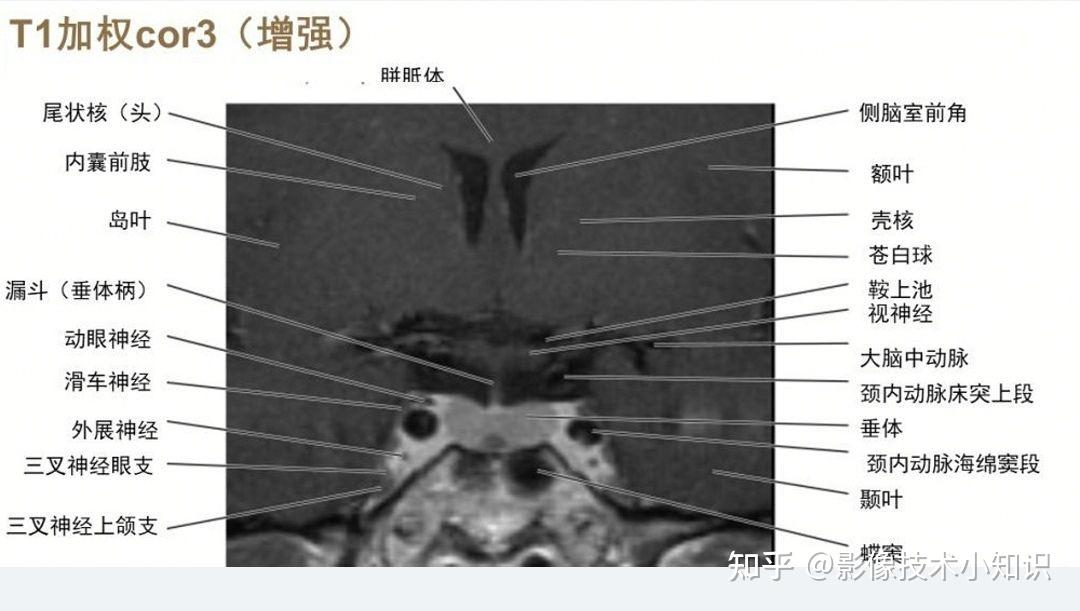 鞍区磁共振图片