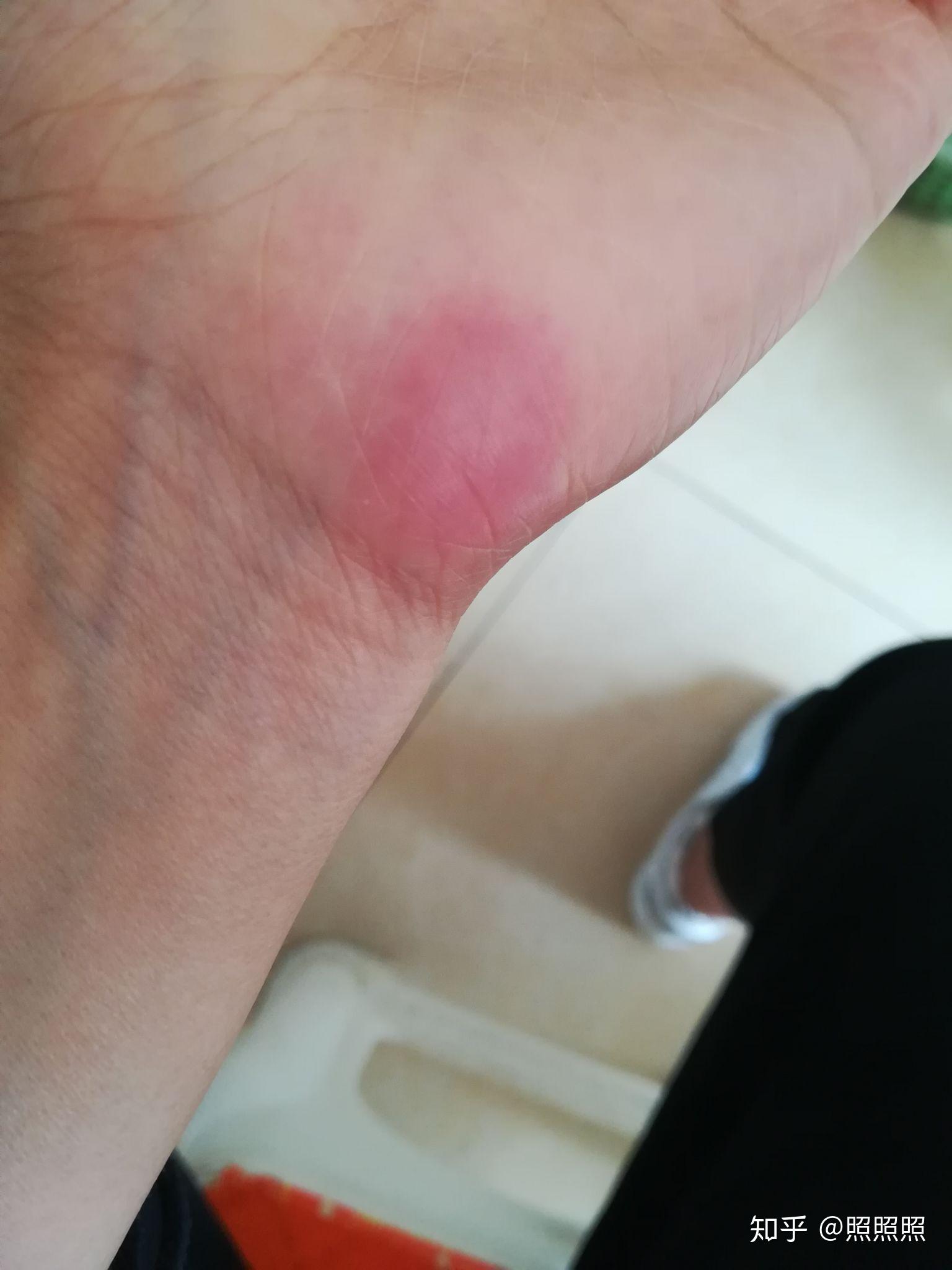 手上有红斑是什么情况