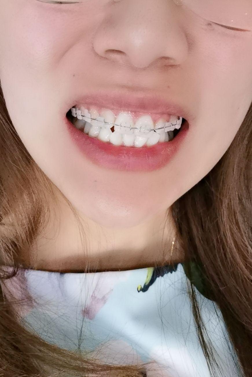 88年老阿姨正畸之旅