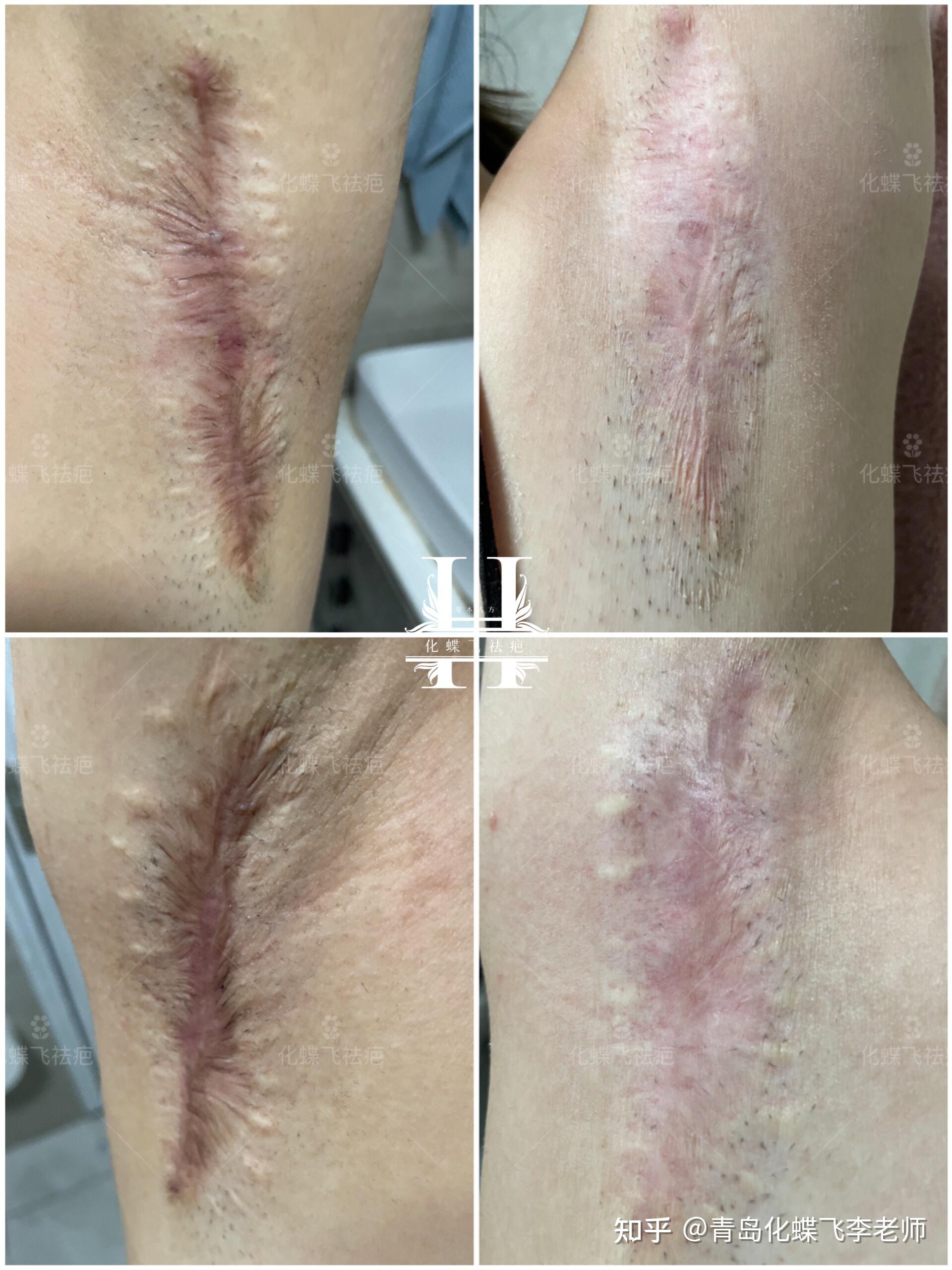 严重的二次手术腋下疤痕
