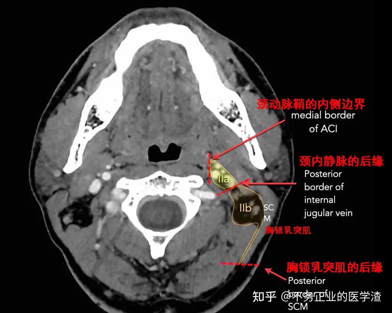 颈静脉孔ct解剖图图片