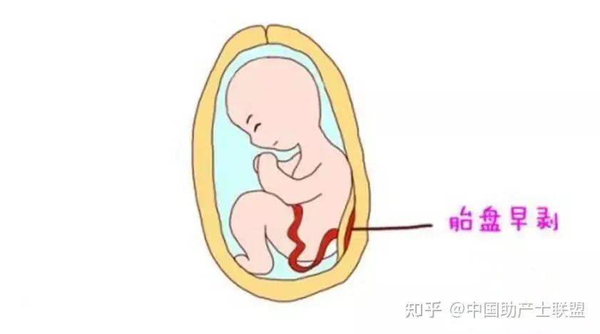 懷孕35周醫生摸了她肚子後嚇一跳馬上剖快助產聯盟