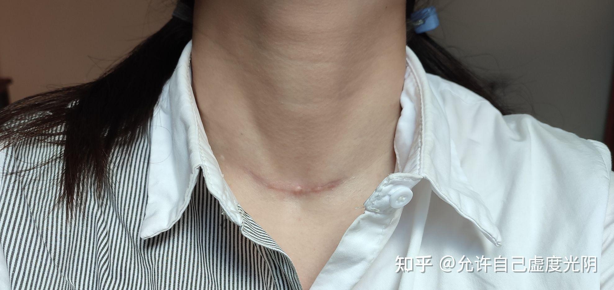 乳腺纤维瘤手术留的疤痕到是什么样子手术会不会很疼明早做手术疤痕会