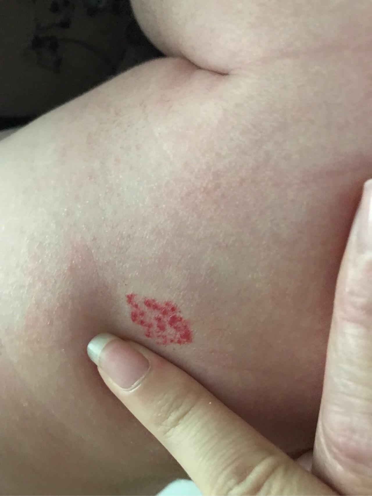 婴儿皮肤血管瘤治疗方案