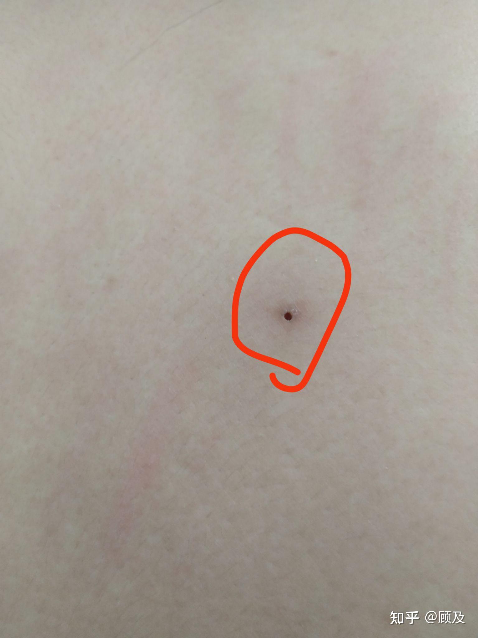 从背上挤出一个小颗粒特硬半粒米大小挤出来之后背