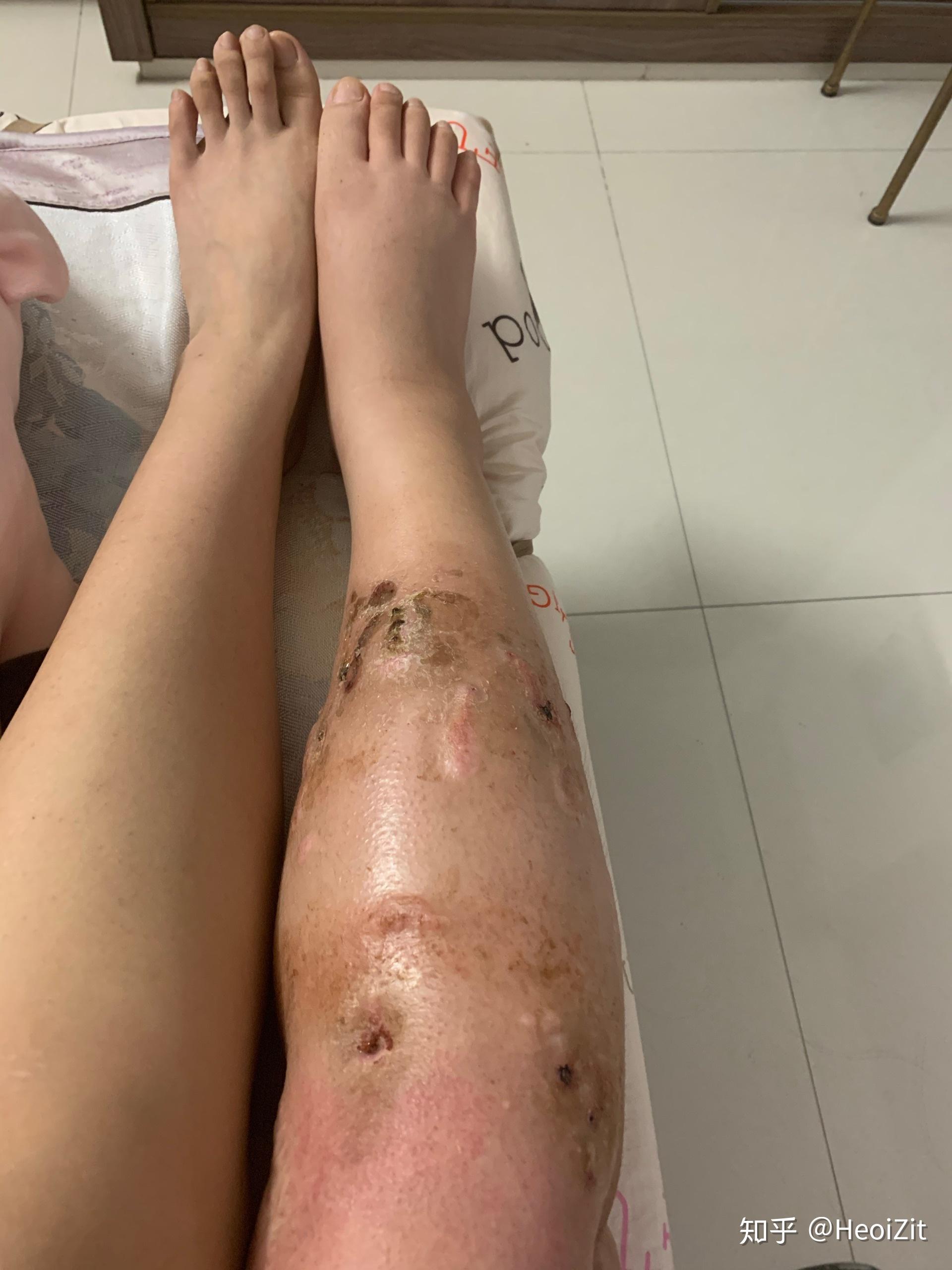 骨延长真的那么痛吗