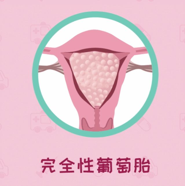 葡萄胎,因妊娠后胎盘绒毛滋养细胞增生,间质水肿,而形成大小不一的
