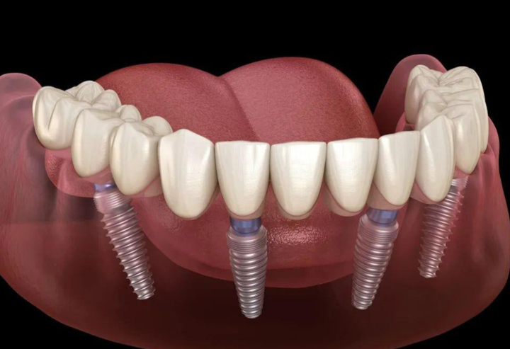 全口种植牙效果图片图片