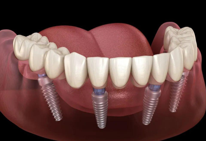 种植牙效果怎么样,在成都该在哪里做全口种植? - 知乎