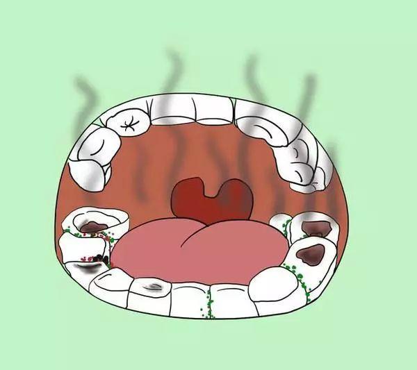 牙结石丨怎么形成的如何预防