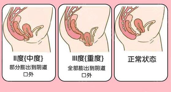 阴壁膨出症图片