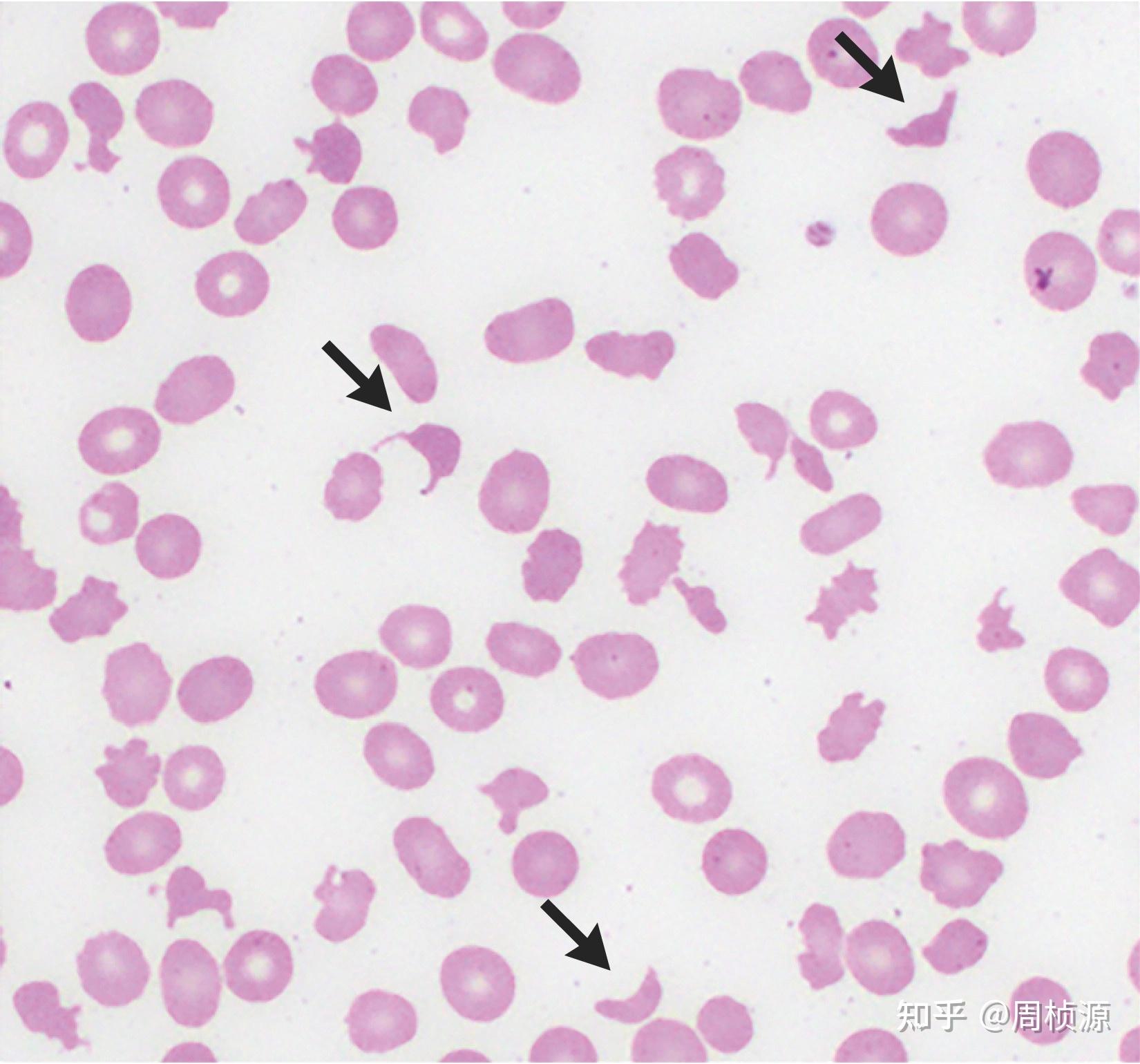 外周血涂片示破碎红细胞,红细胞大小不等,血小板少,伴大血小板,白细胞