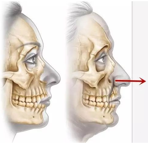 随着年龄增长,鼻骨逐渐流失,梨状孔扩大,鼻基底日渐塌陷,鼻子慢慢失去