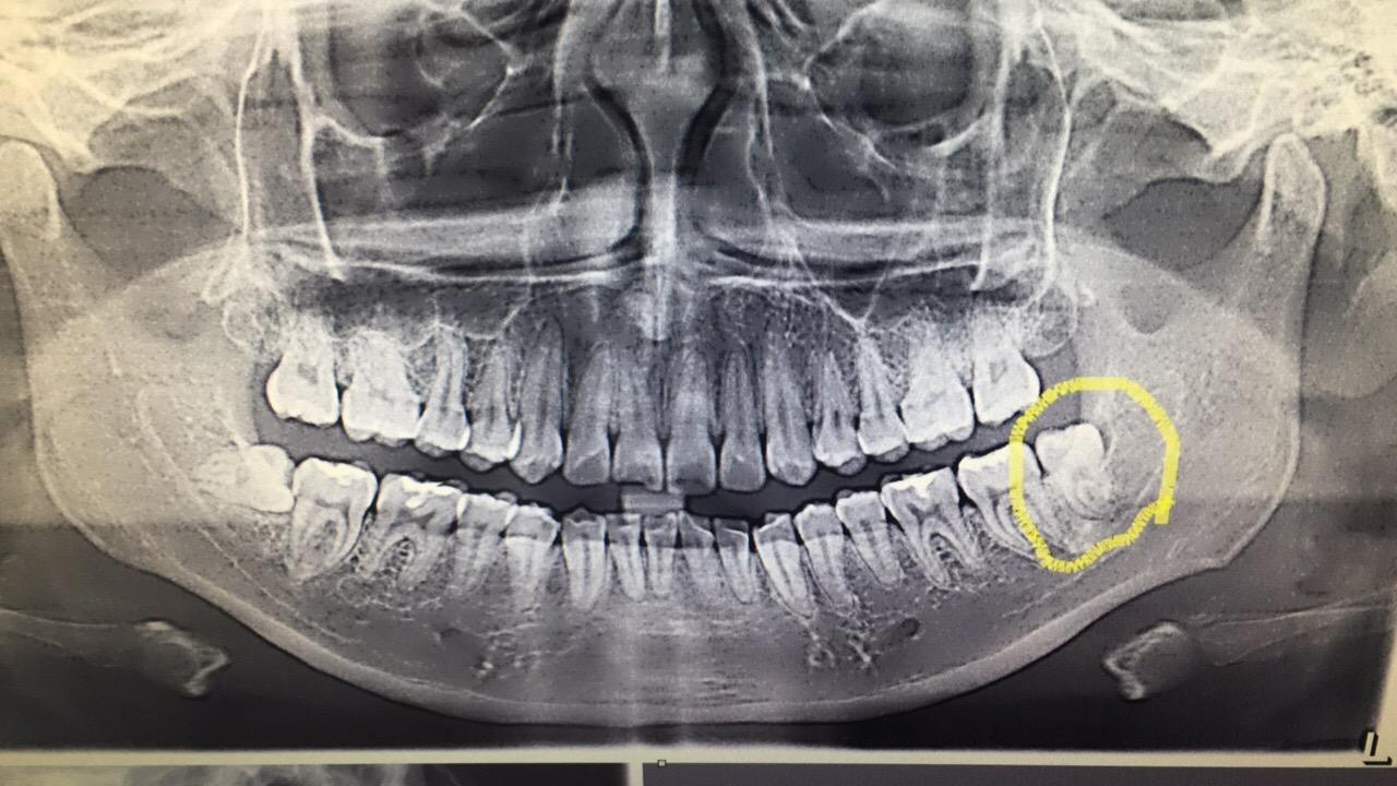 口腔x光片怎么分左右?
