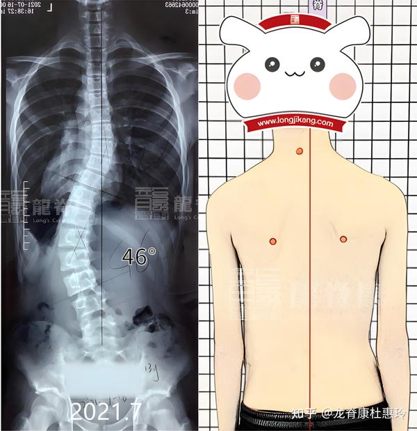 脊柱侧弯训练,为什么要强调呼吸发力的重要性? - 知乎