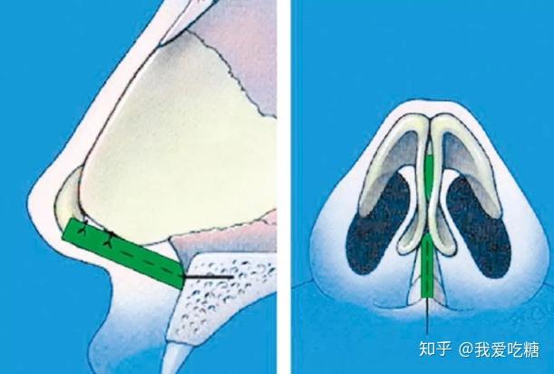 鼻骨内推和鼻骨鼻骨该怎么选择