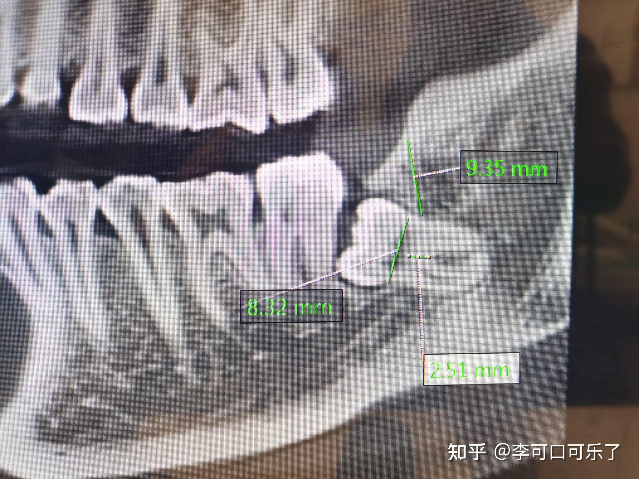 低位垂直阻生齿图片