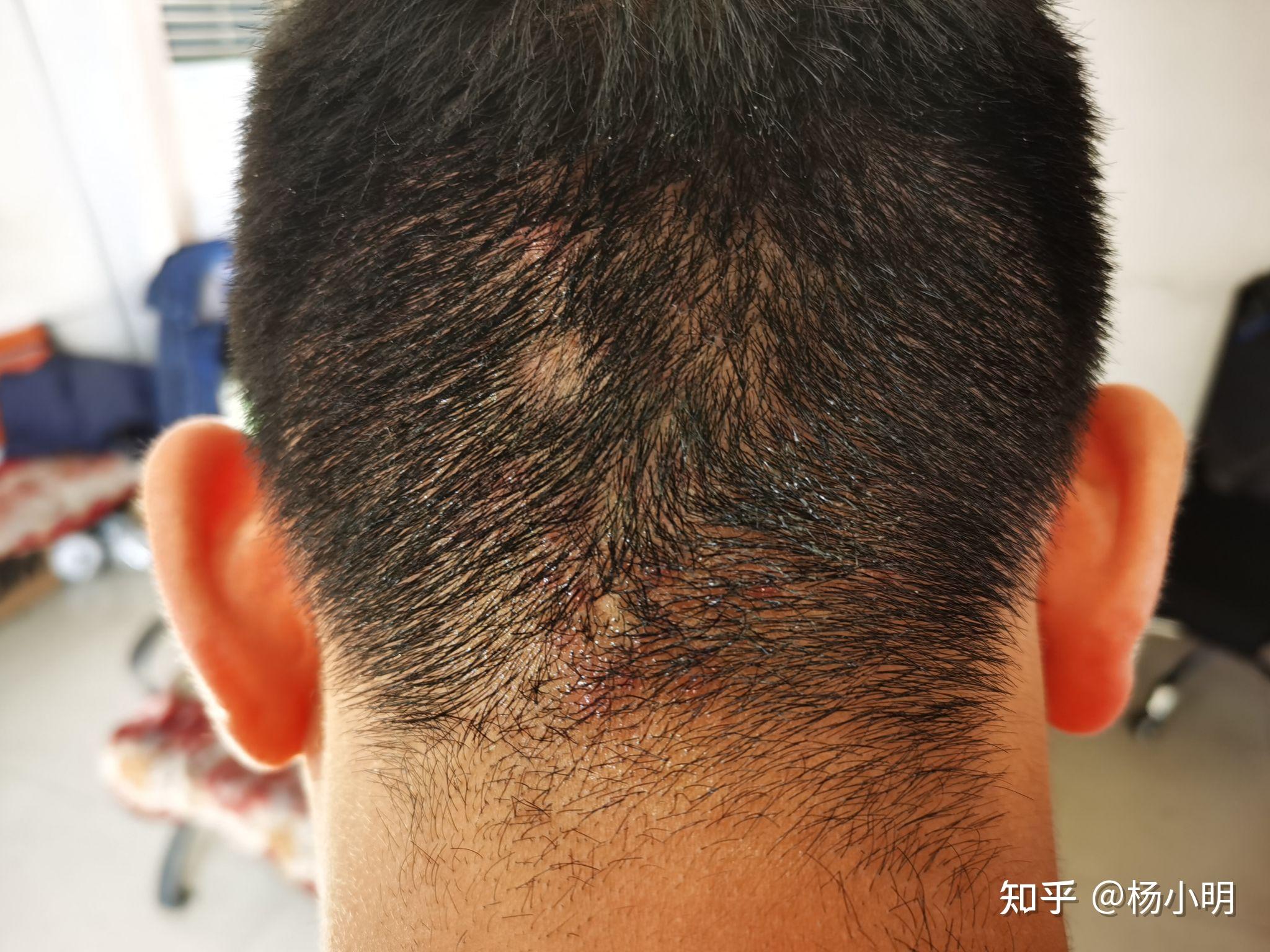 脑袋后面长了好多小疙瘩? - 知乎