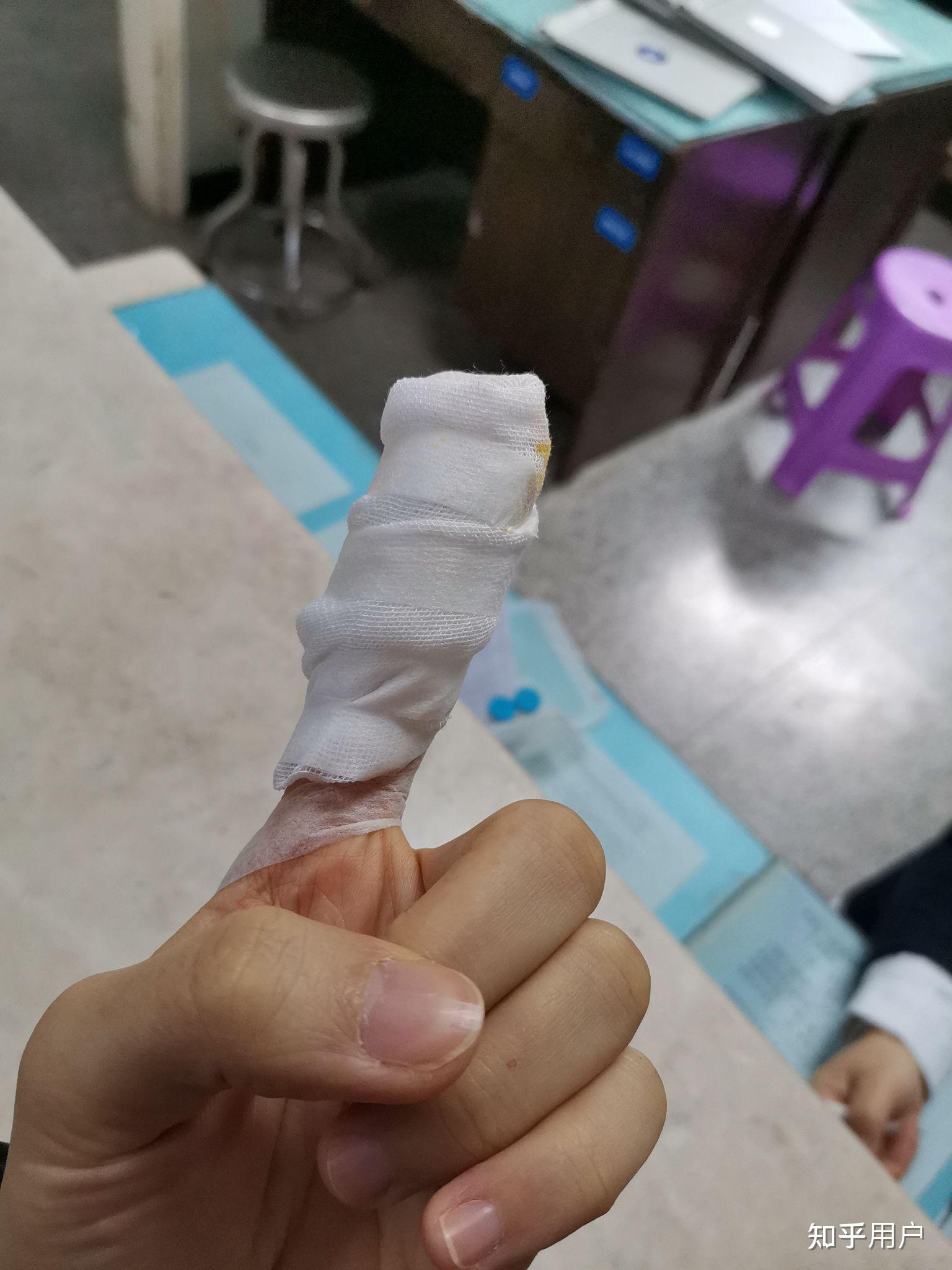 哺乳期打破伤风针能喂母乳吗? - 知乎