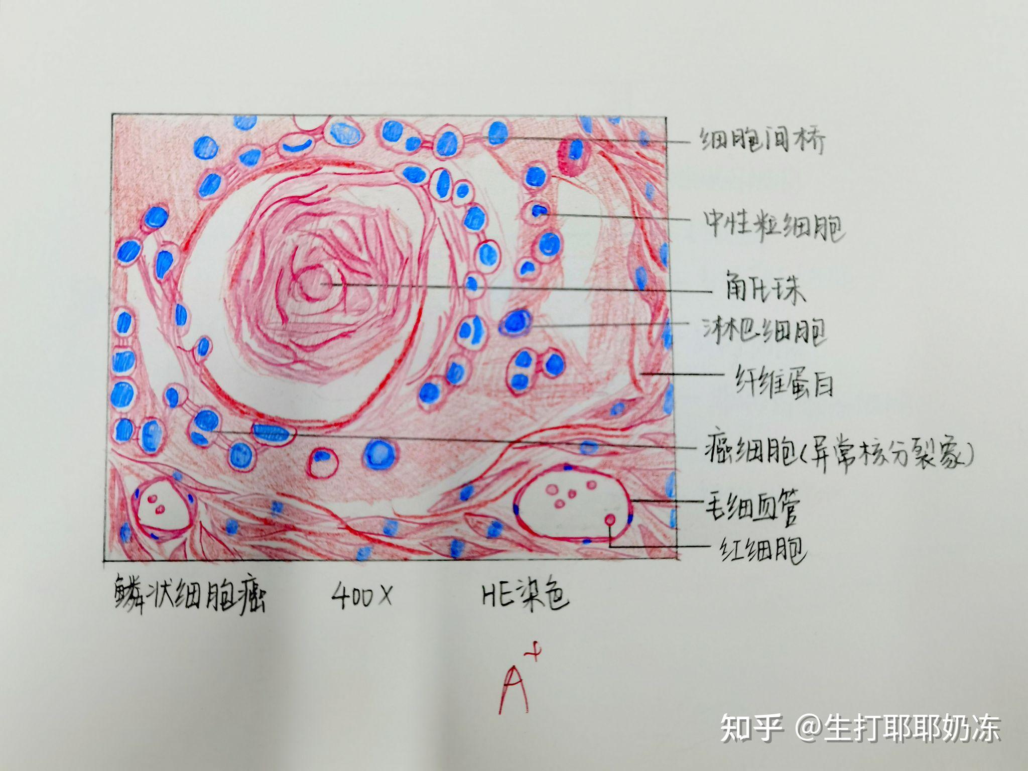 高分化腺癌红蓝铅笔图图片