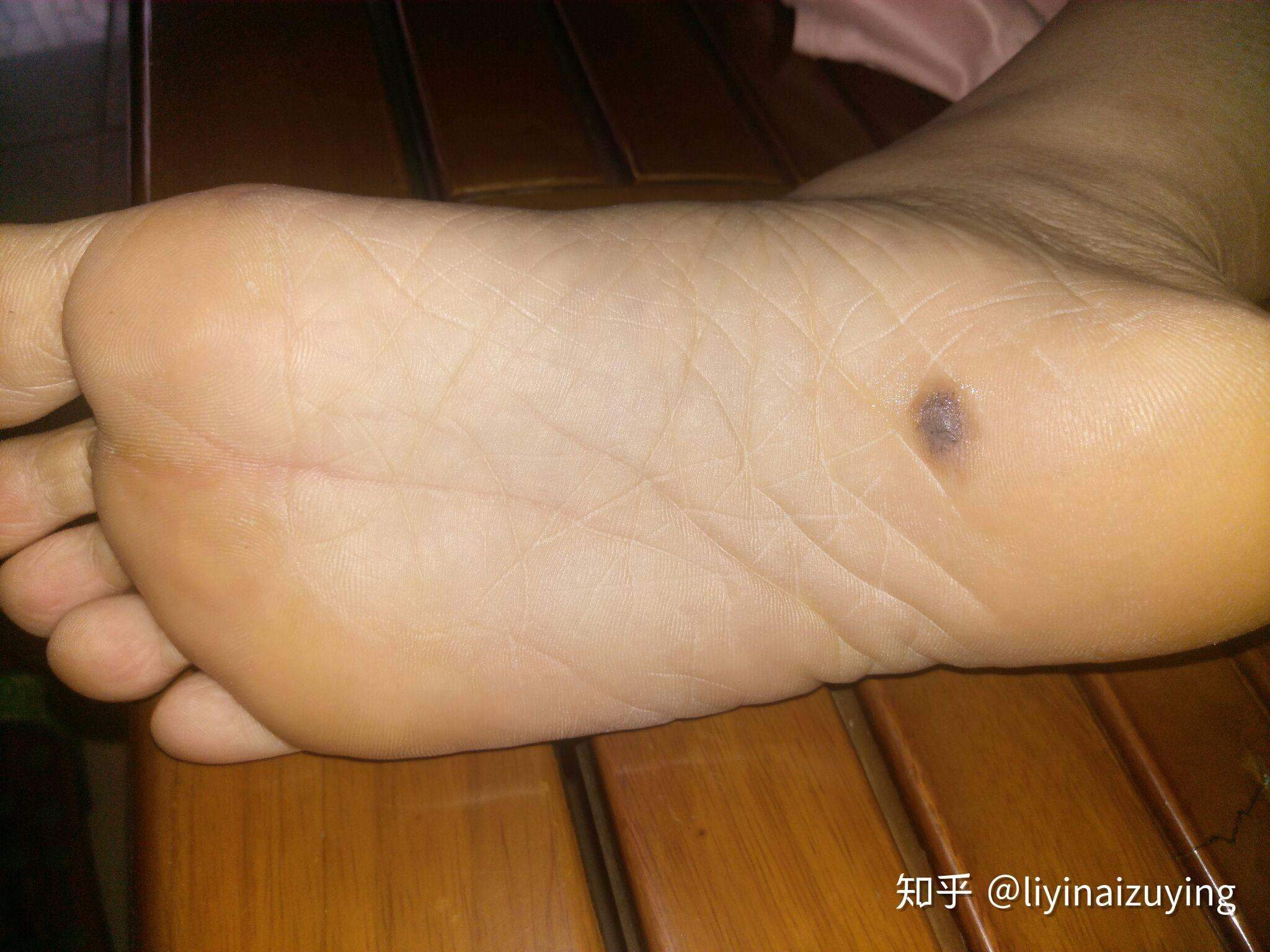 谈(色素)痣色变之自己吓自己