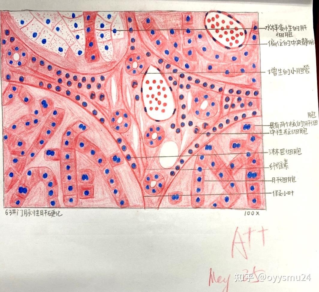 肾脓肿细胞图描述图片