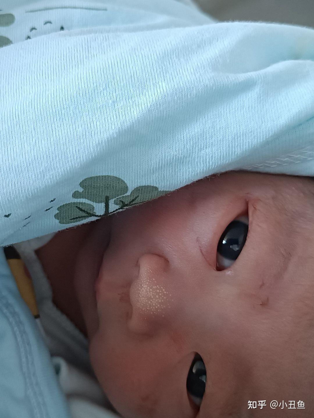新生儿鼻子上有白点点是什么东西? - 知乎