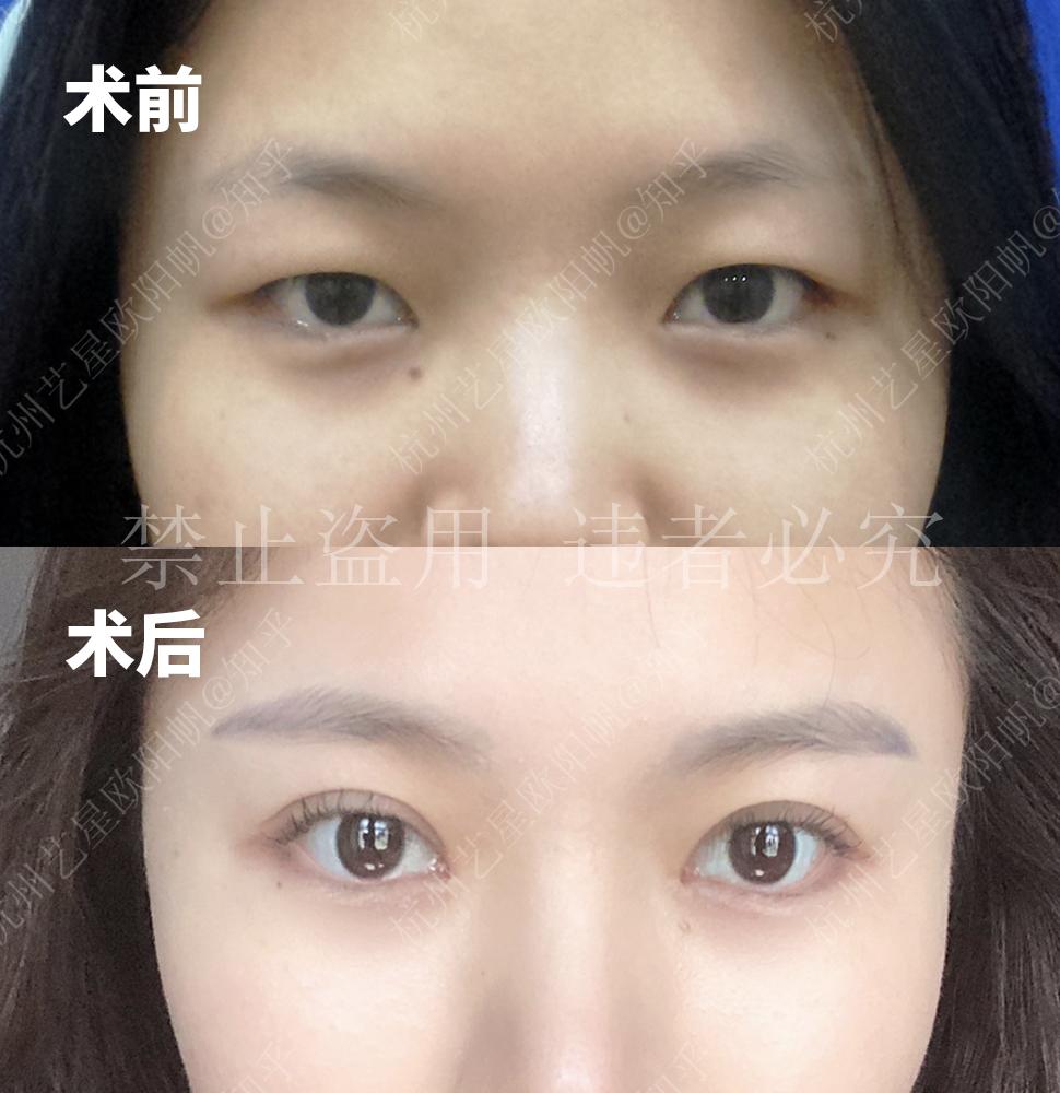 常见双眼皮的类型包括哪些,有哪几种? - 知乎