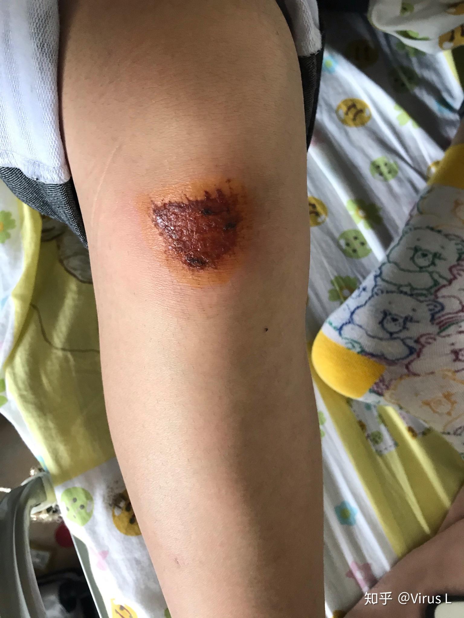 骑车侧翻膝盖摔伤破皮,怎么处理伤口,怎样才能不留疤? - 知乎