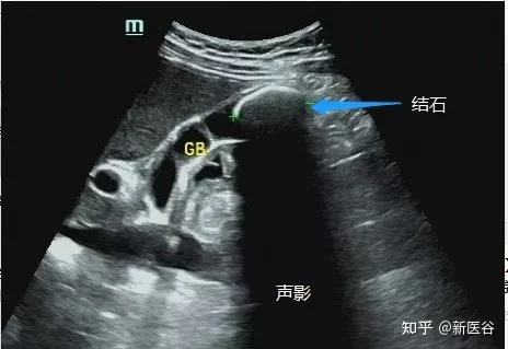 跟谷谷一起看病案学外科《腹股沟疝》