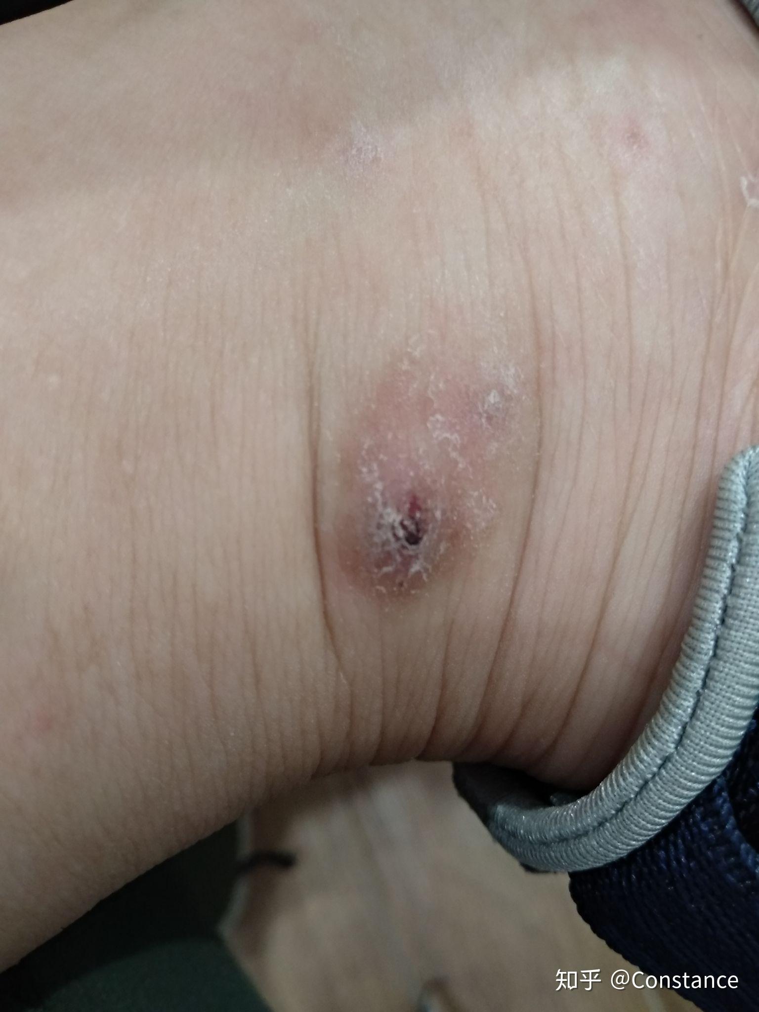 各位大神被蚊子咬了之后你们的包会变成这样吗? - 知乎