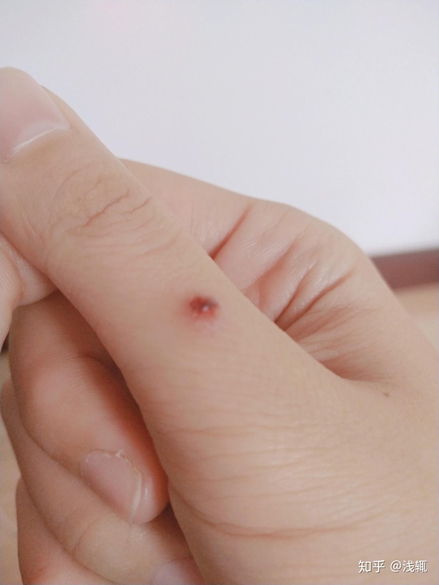 手上长了瘊子该怎么治疗求帮助