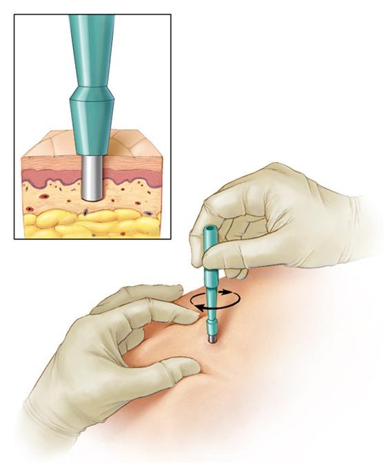 穿刺活检会引起癌症扩散或转移吗