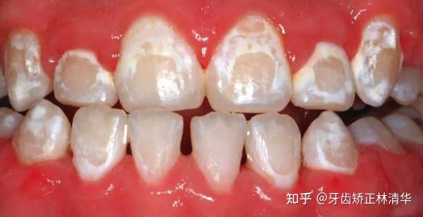 厦门牙齿矫正|正畸治疗中的釉质脱矿 - 知乎