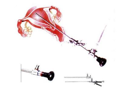 一文了解导丝介入疏通输卵管