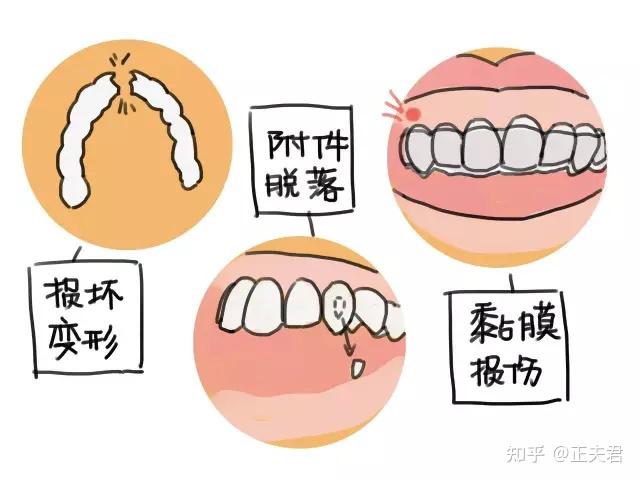 part 01关于牙套摘戴方法