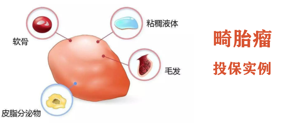 体检查出畸胎瘤 我还能买保险吗 附真实成功投保案例 知乎