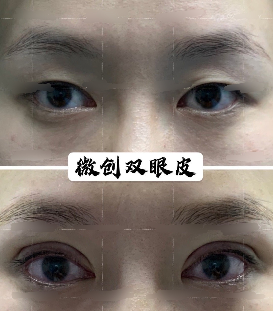 武汉协和杨杰做的双眼皮，微创双眼皮1个月 - 知乎