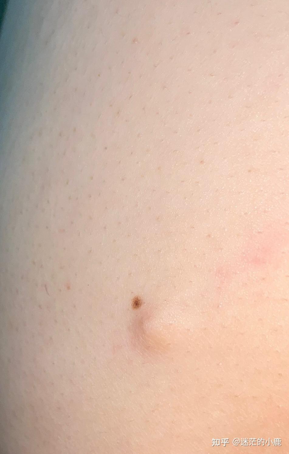 大腿根长了一个包