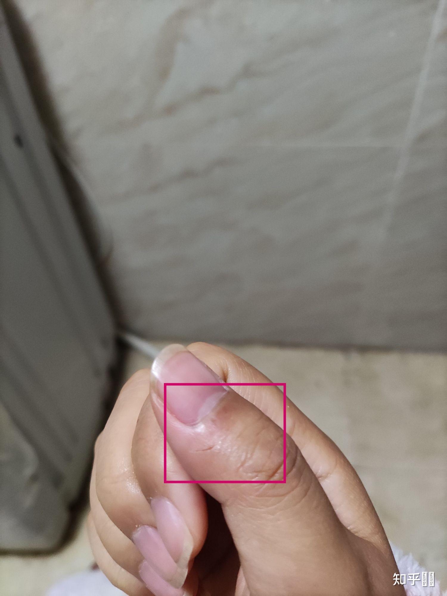 睡觉中经常会紧握住手成拳头状,醒后发现指甲掐的手心很深的印是怎么