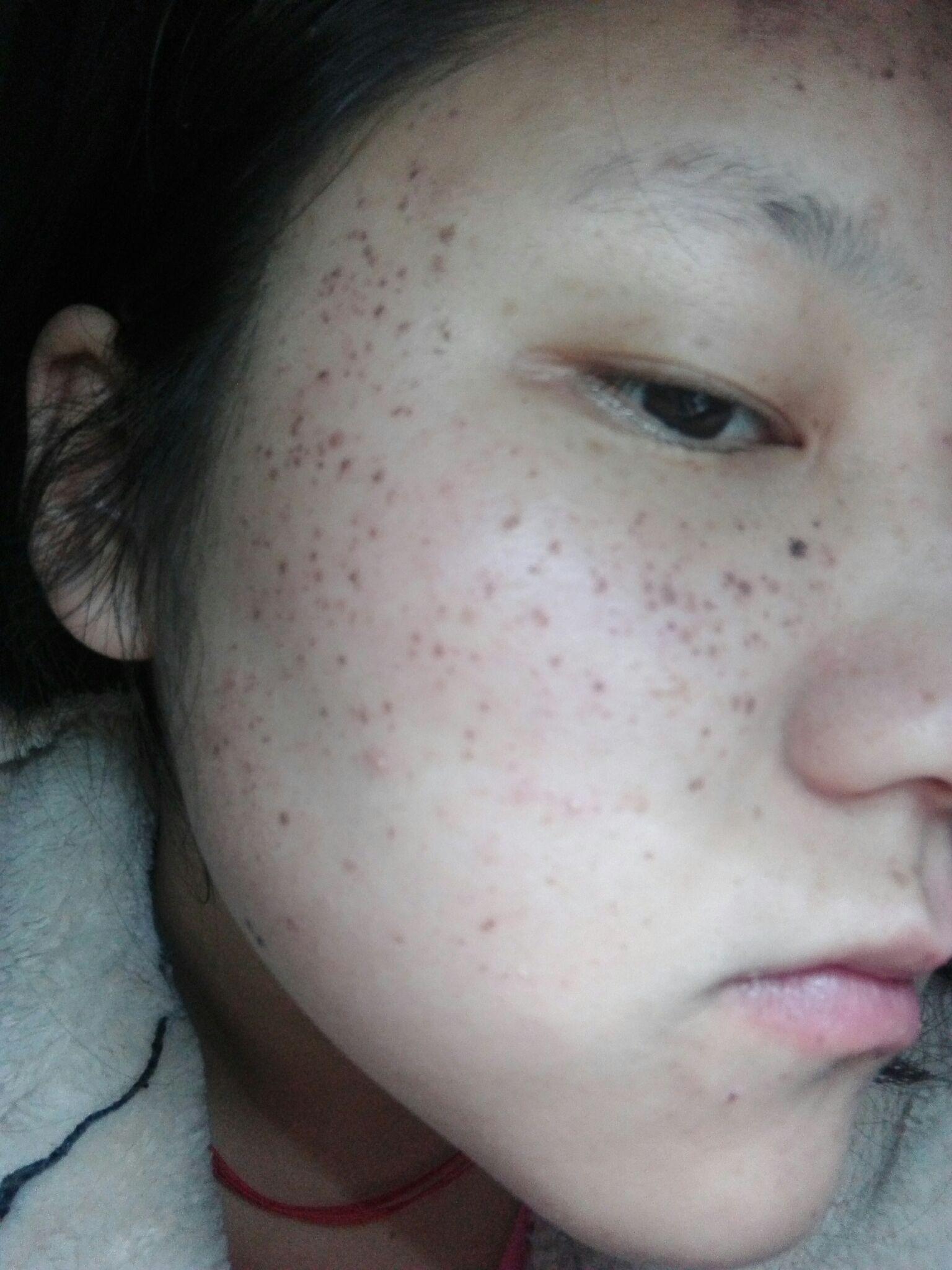 求高人指点治疗遗传性雀斑的最佳方法激光光子