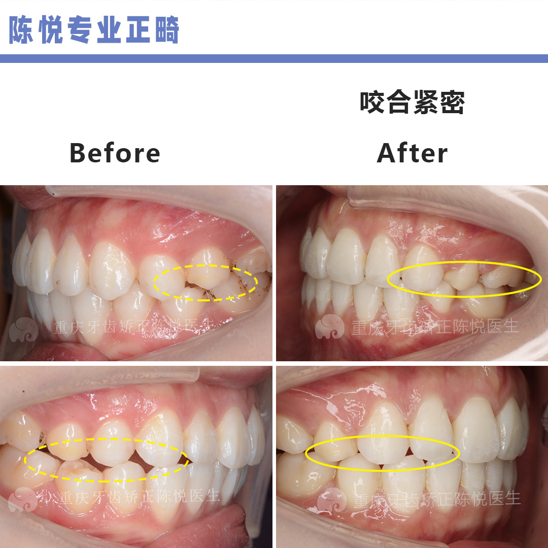 重慶牙齒矯正咬合不佳中線不齊看起來臉歪正畸2年明顯改善