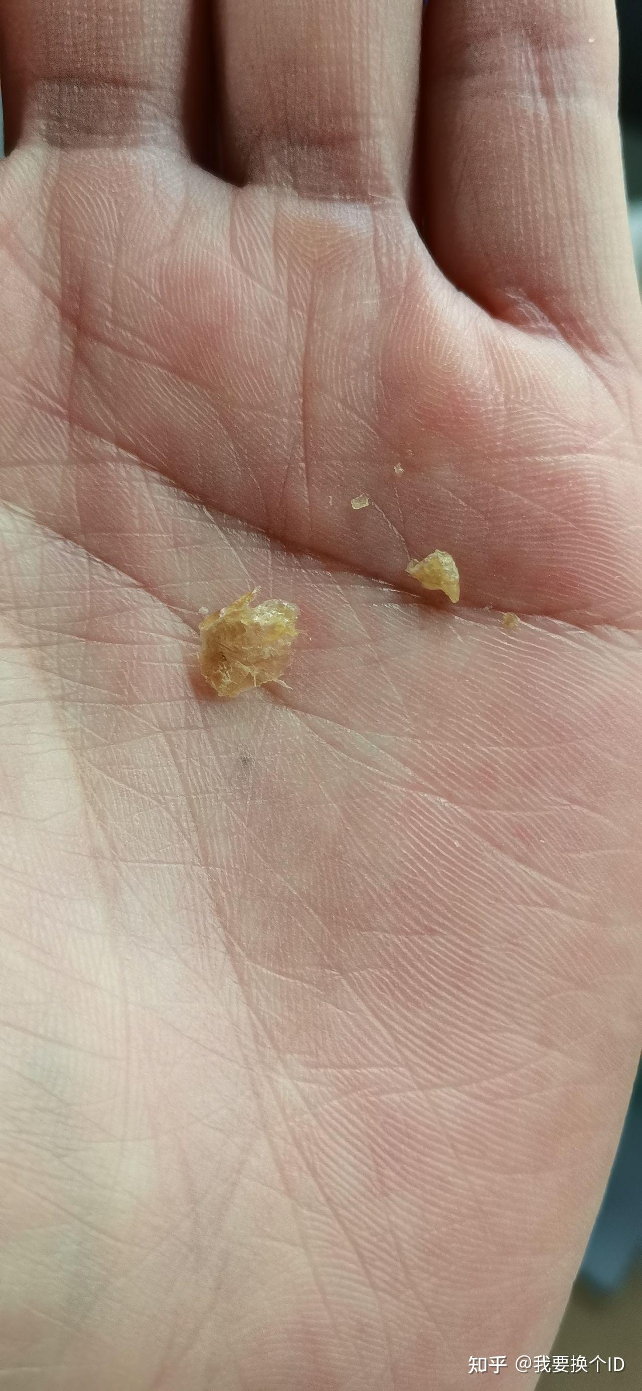 为什么我从来没掏出来过大号的耳耵聍? - 知乎